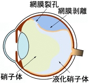 裂孔 生活 後 網膜 術 レーザー