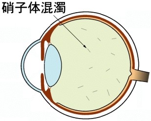 飛蚊症とその治療 医学小知識 飛蚊症とその治療 医学小知識